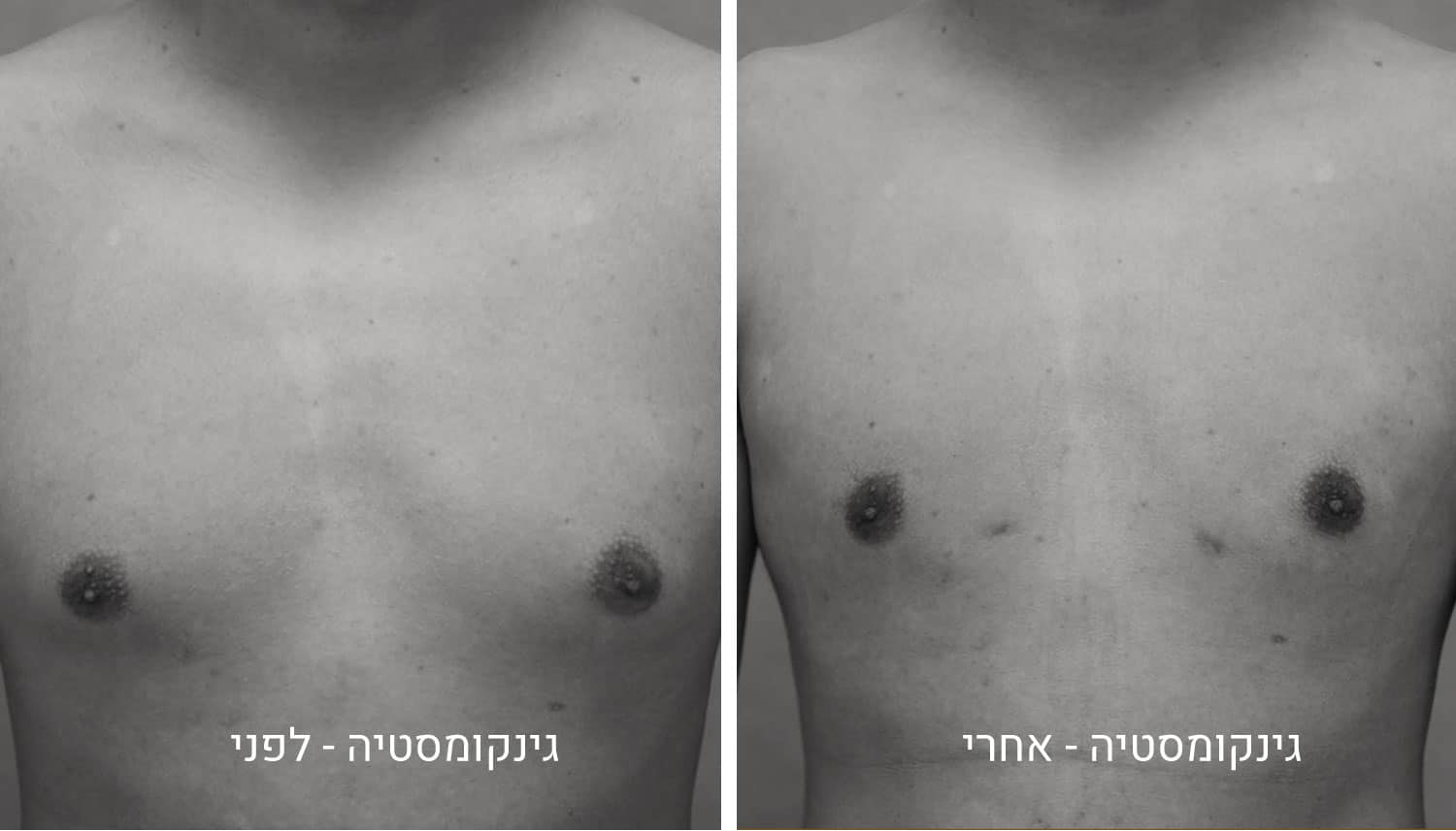 גינקומסטיה שד גברי תמונות לפני ואחרי