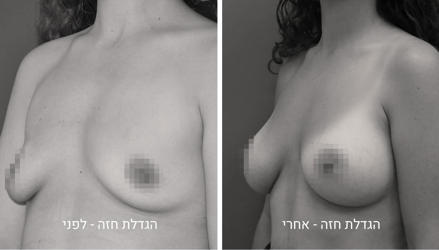 תמונות להגדלת חזה לפני ואחרי