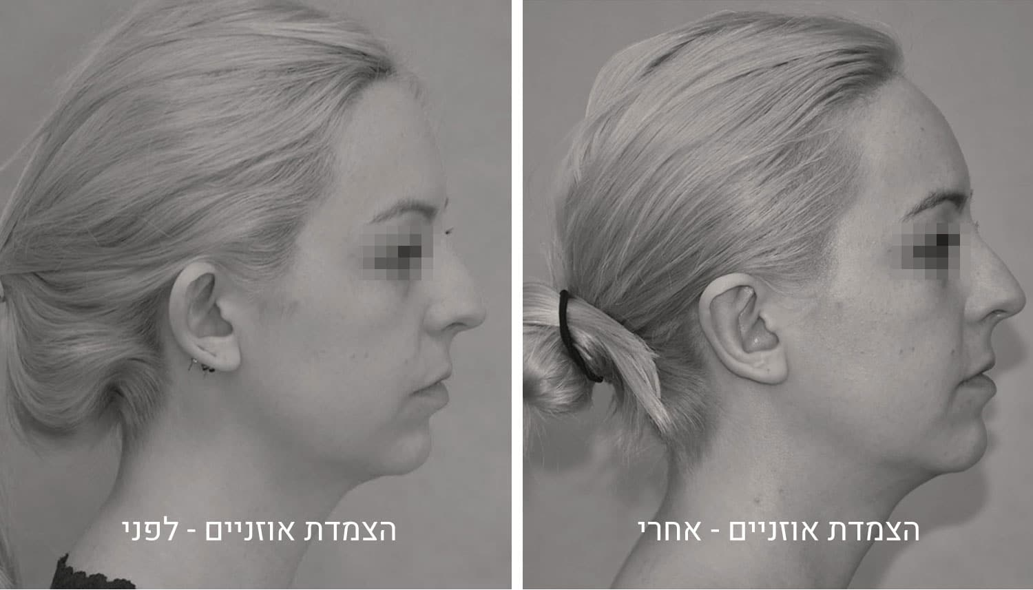 הצמדת אוזניים תמונות לפני ואחרי