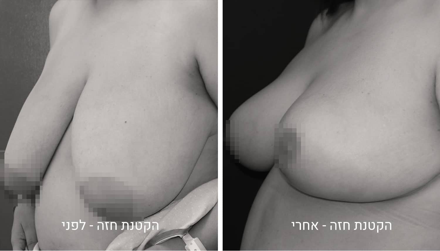 תמונות ניתוח להקטנת חזה לפני ואחרי