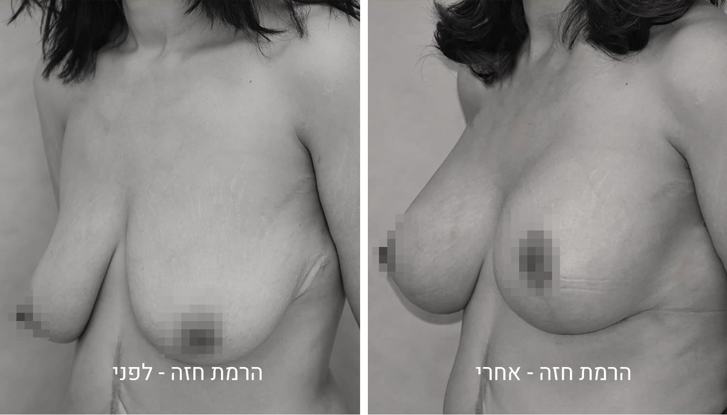 תמונות לפני ואחרי ניתוח הרמת חזה