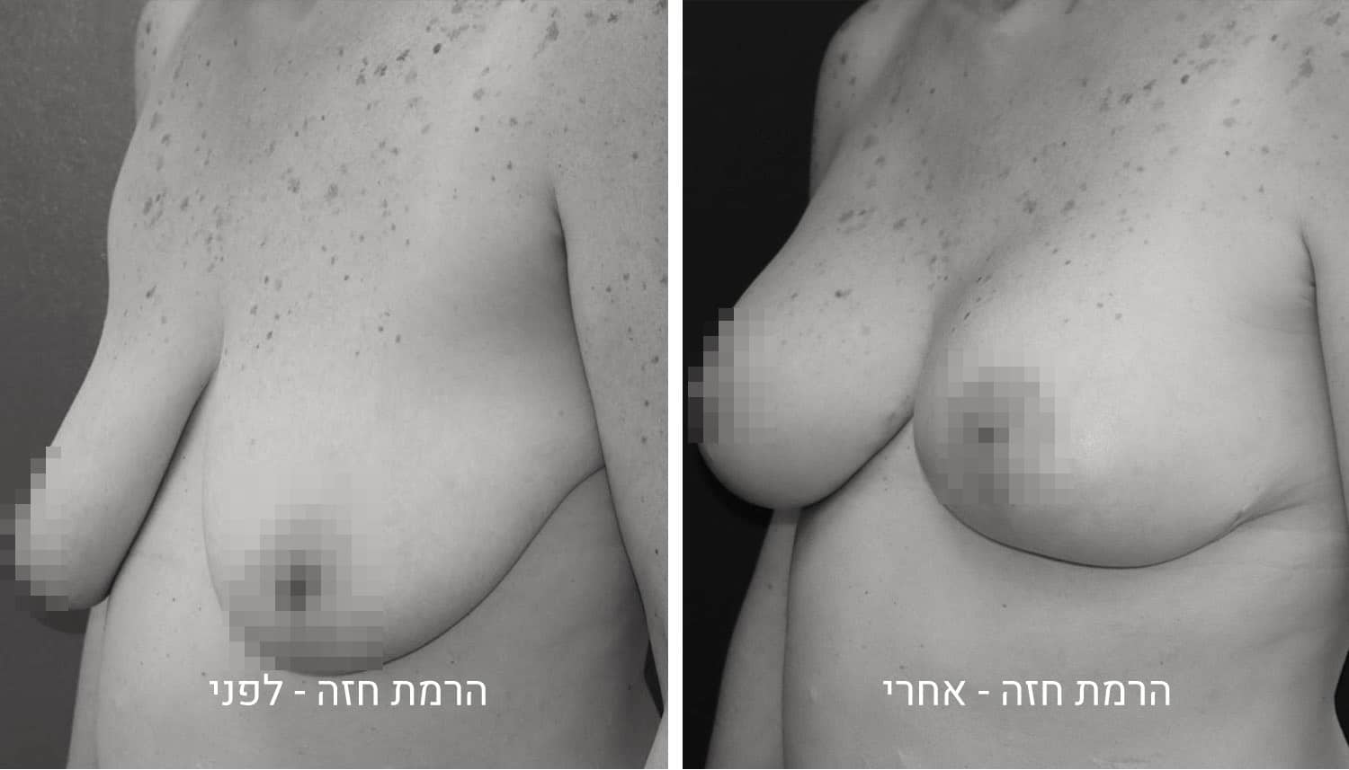 תמונות ניתוח הרמת חזה לפני ואחרי