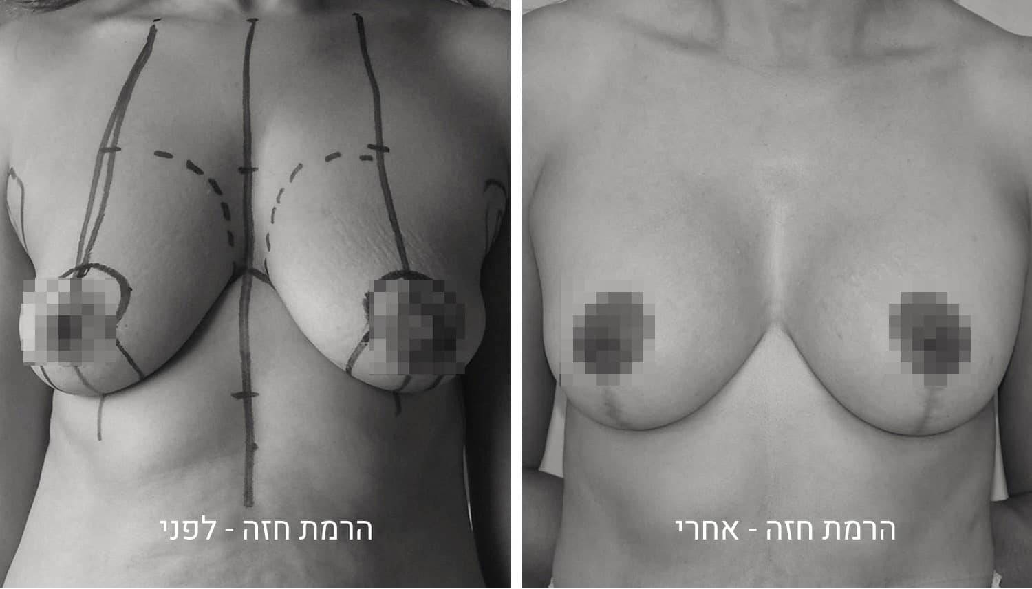 תמונות לפני ואחרי ניתוח הרמת חזה