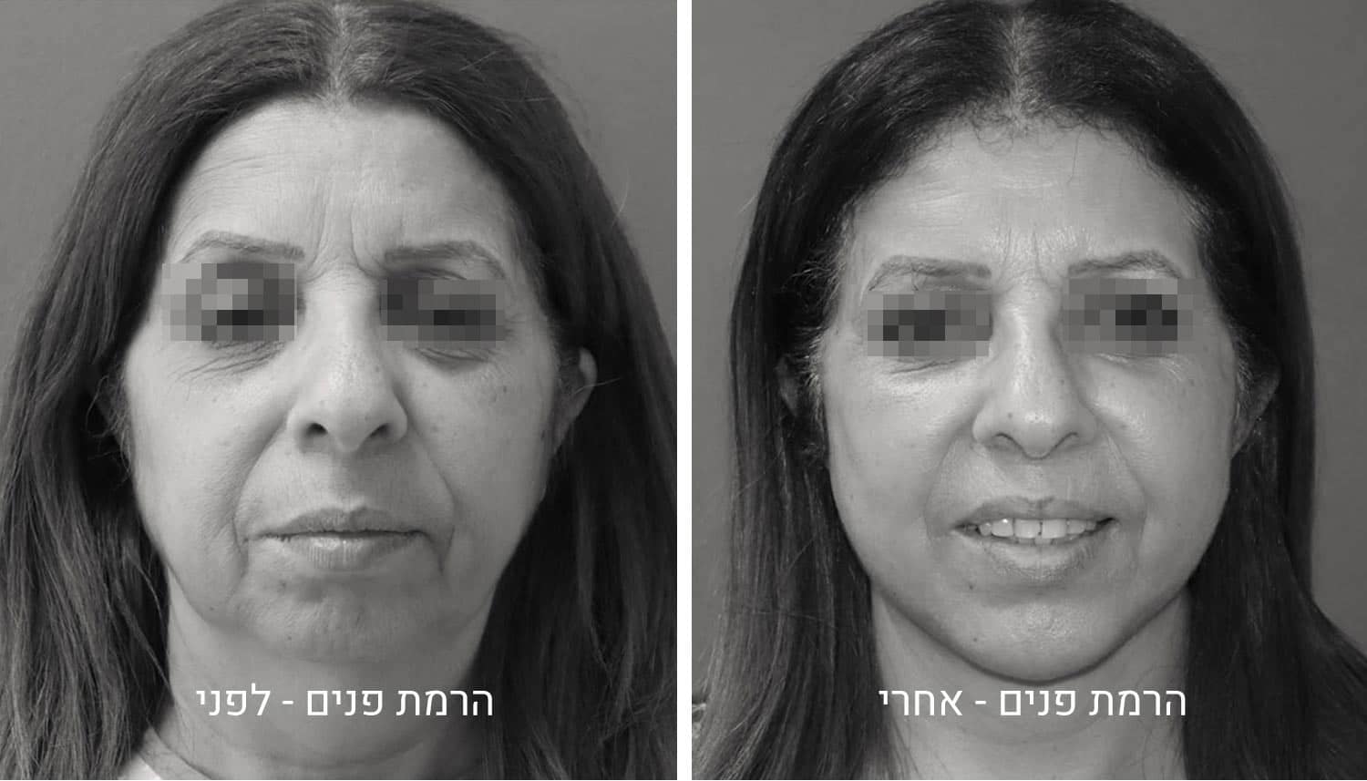 הרמת פנים תמונות לפני ואחרי גיל נרדיני