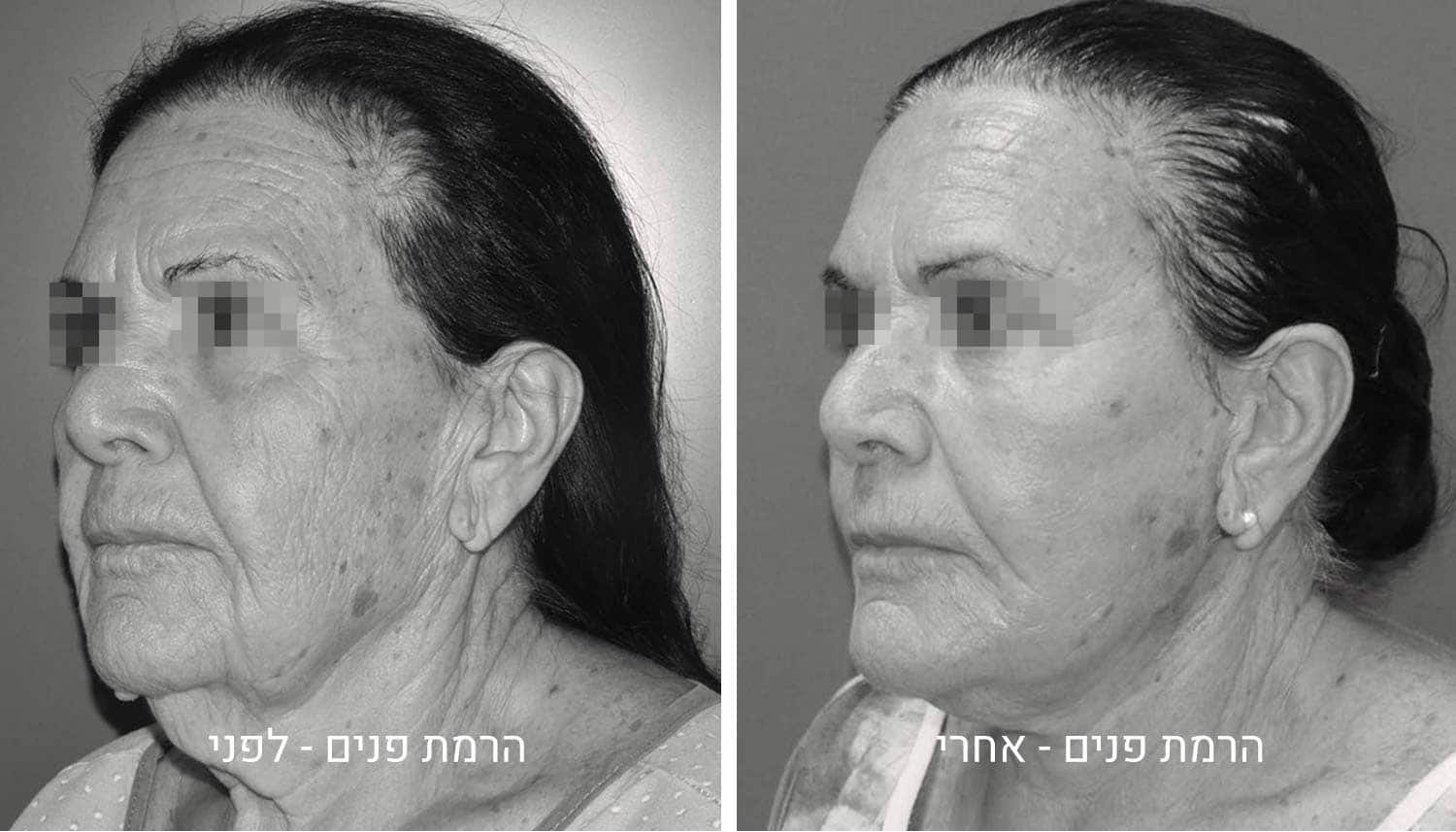 ניתוח הרמת פנים תמונות לפני ואחרי גיל נרדיני