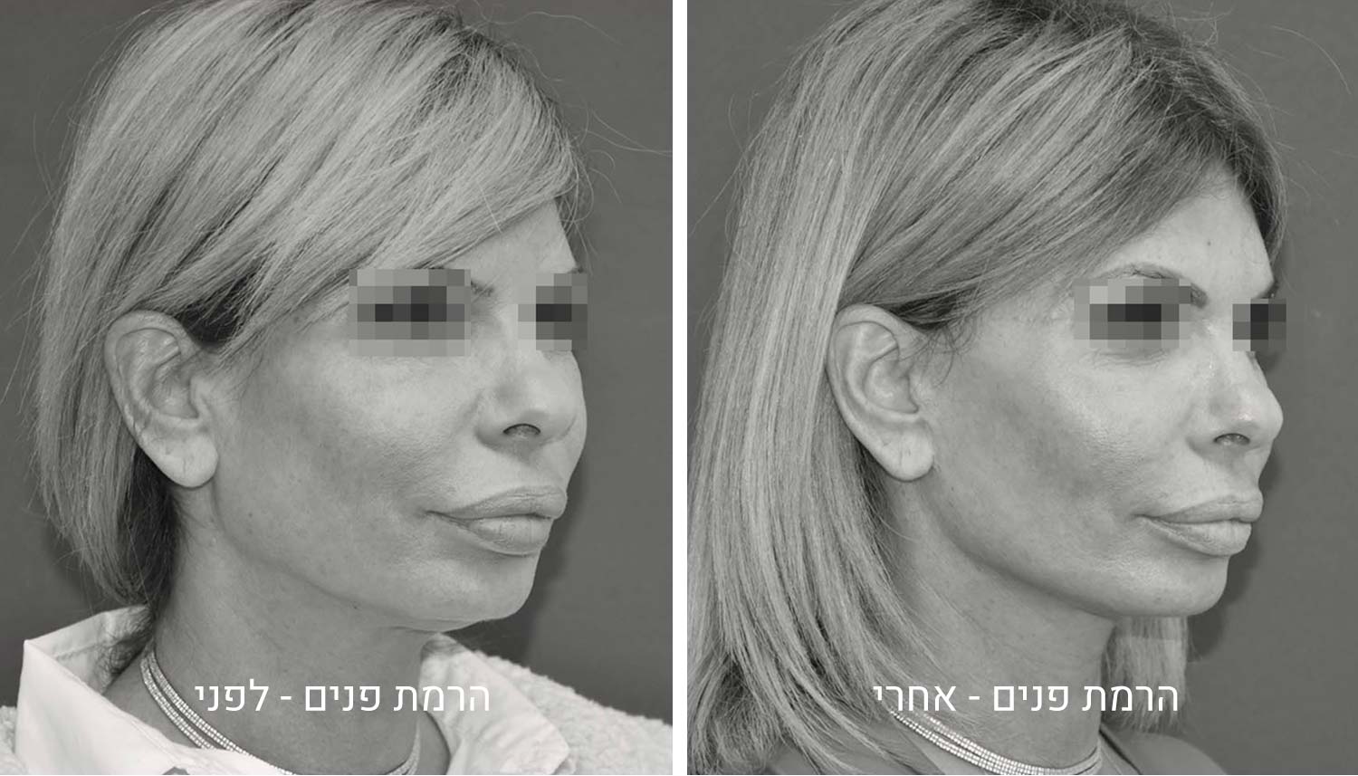 ניתוח הרמת פנים תמונות לפני ואחרי