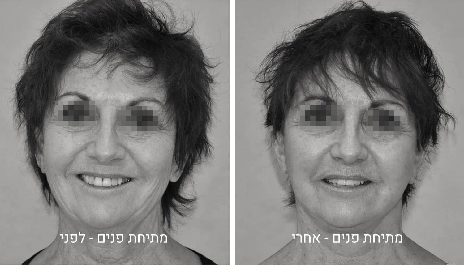 מתיחת פנים תמונות לפני ואחרי 1