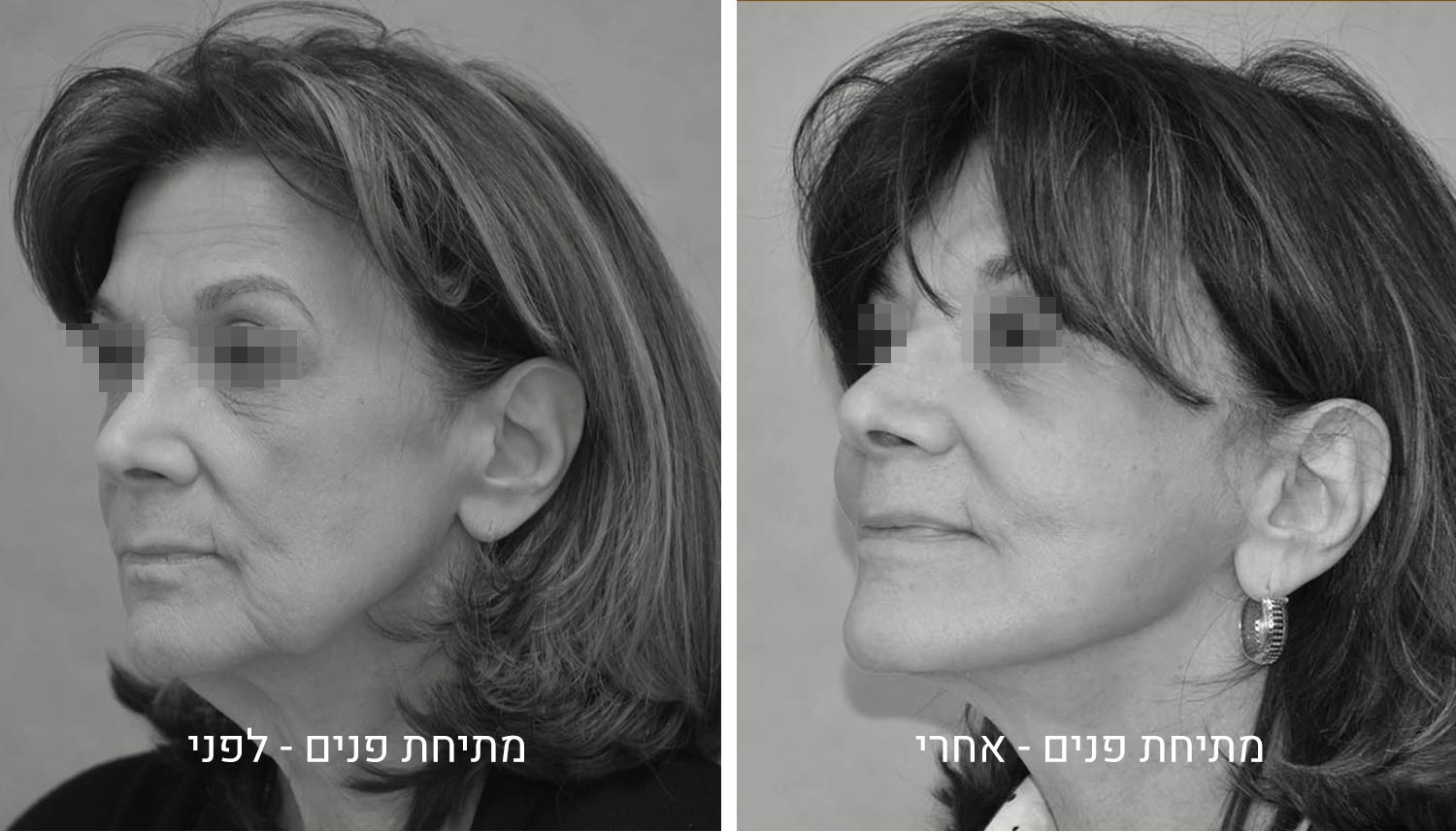ניתוח מתיחת פנים תמונות לפני ואחרי גיל נרדיני