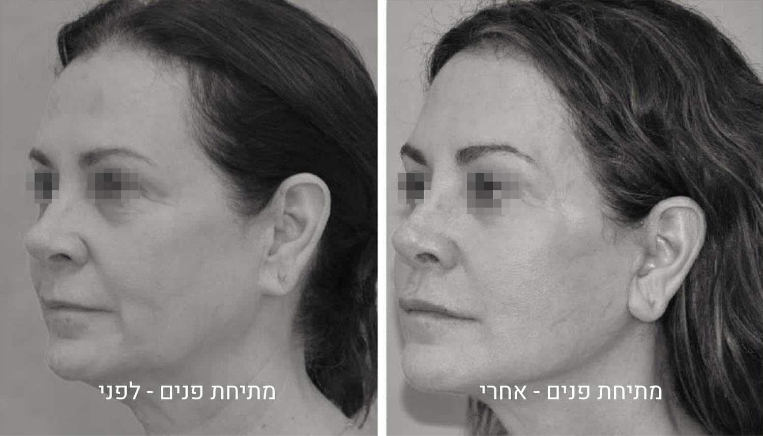 מתיחת פנים תמונות לפני ואחרי