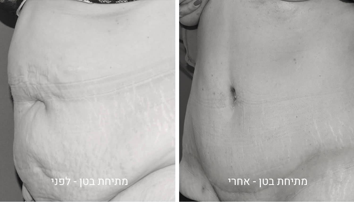 מתיחת של בטן תמונות לפני ואחרי 1