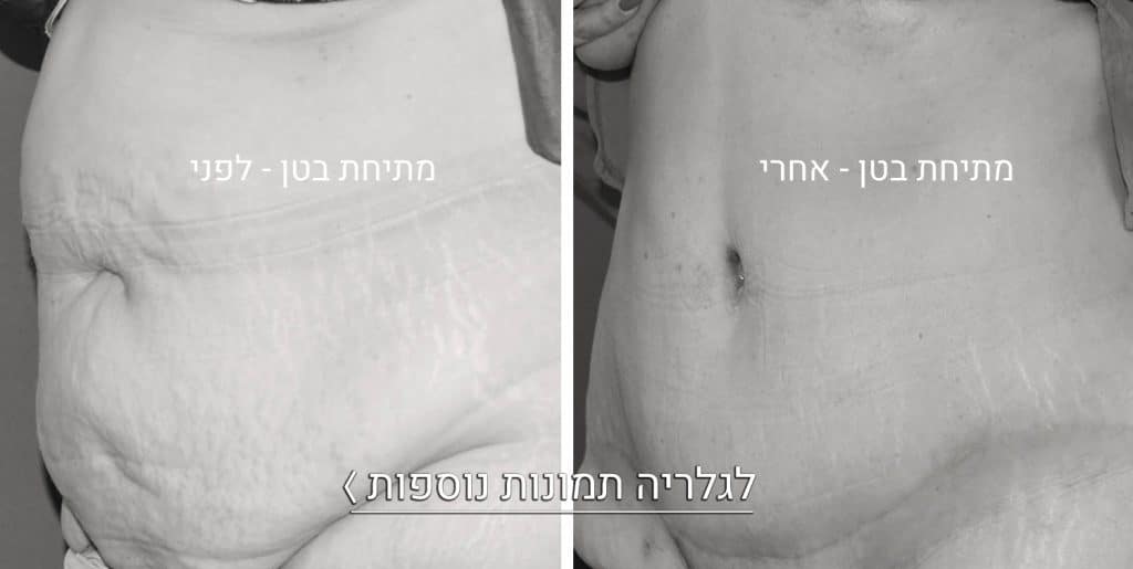 מתיחת של בטן תמונות לפני ואחרי
