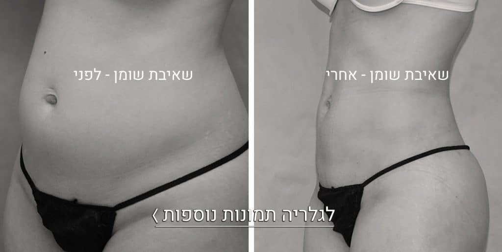 שאיבת שומן תמונות לפני ואחרי 2