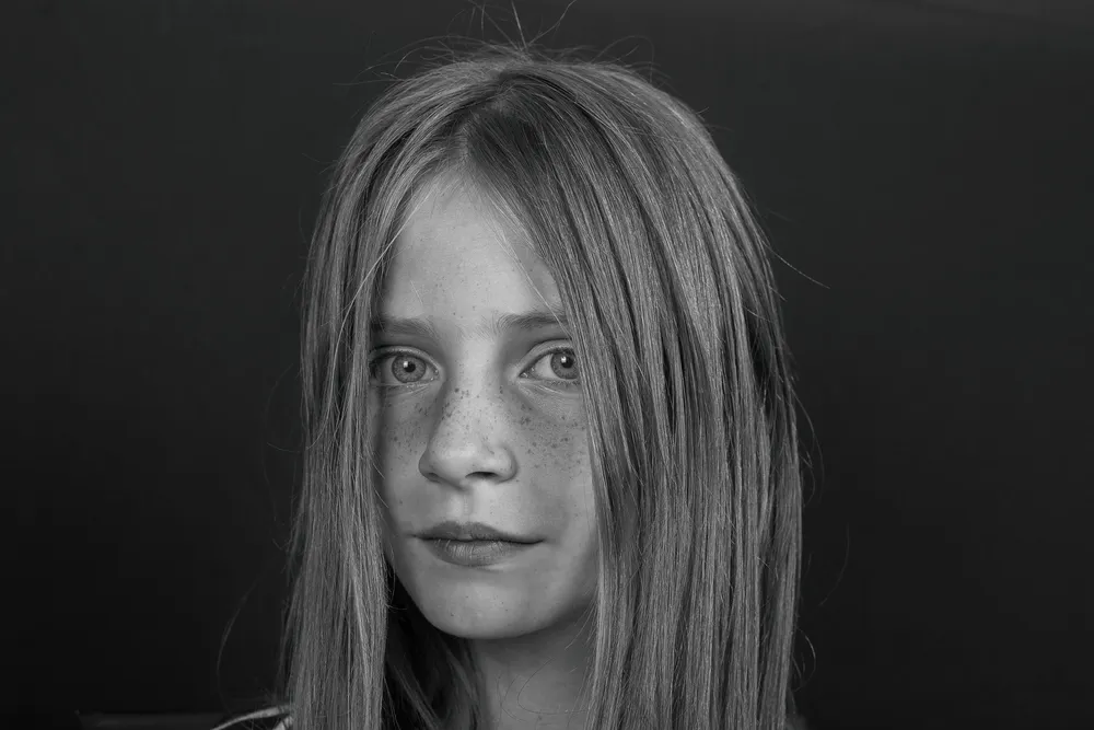 תמונה לפוסט הצמדת אוזניים לפני/אחרי